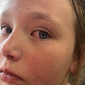 Pink Eye